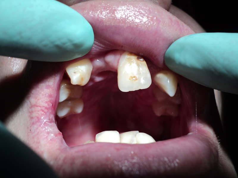 Implant dentar Sibiu